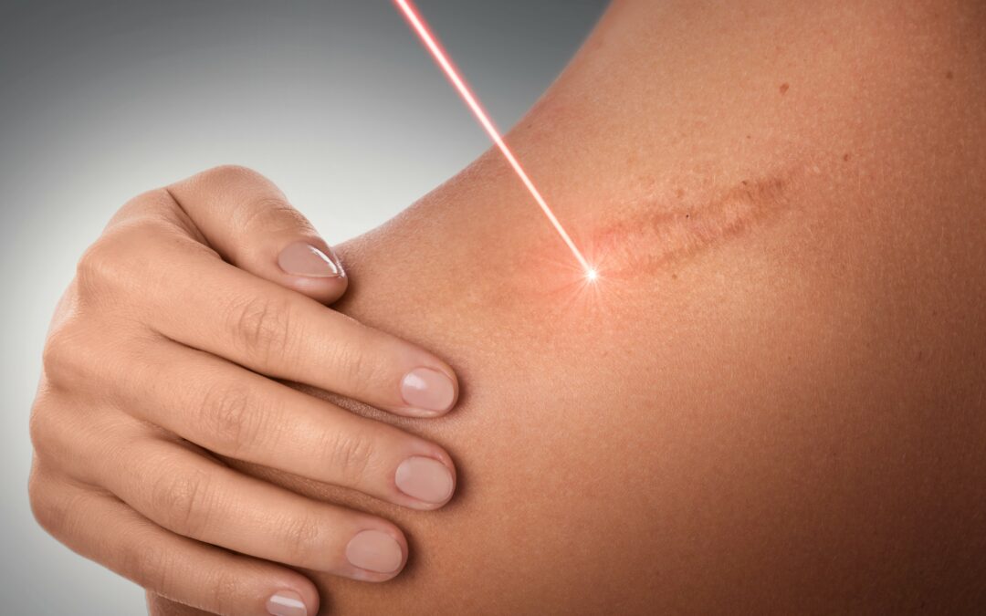 Everything you want to know about laser scar removal